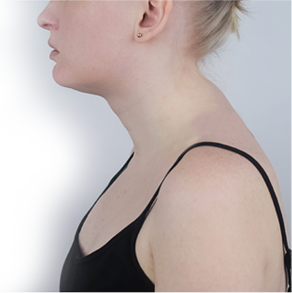 la-gobba La cifosi (o gobba), è una delle complicanze più gravi della spondilite anchilosante.